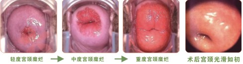 轻、中、重度宫颈糜烂如何区分