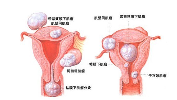 计划怀孕却查出有子宫肌，要暂停怀孕吗？