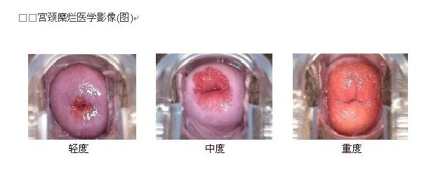 宫颈糜烂2度严重吗