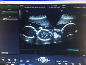四维彩超技术再获突破 玛丽亚医院查出罕见的三胞胎