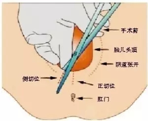 为啥顺产了还要挨一刀？避免私处挨一刀，一定要看这个......